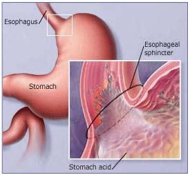 Acid Reflux -LES