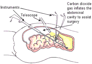 labaroscopic fundoplication